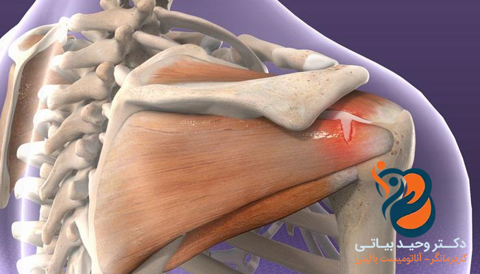 التهاب تاندون شانه چیست؟