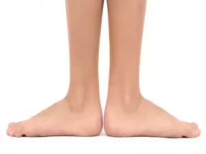 صافی کف پا در کودکان